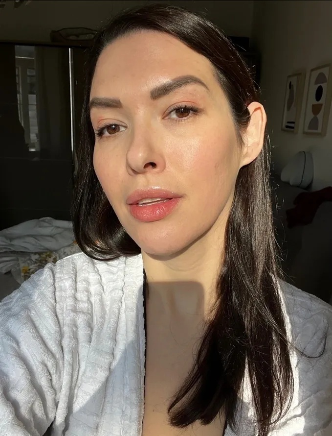 How I Cleared My Acne with Bioptron Light Therapy
